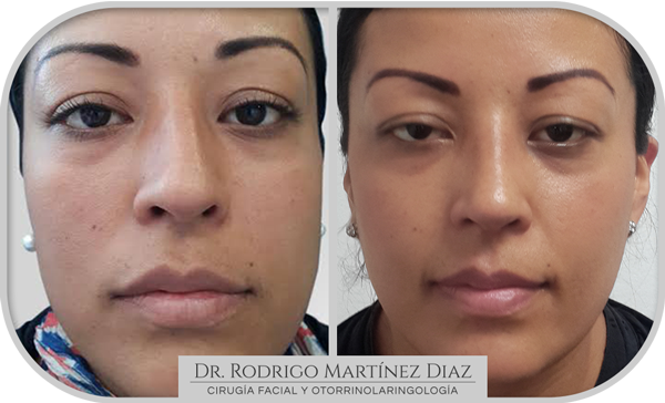 img_rinoplastia_P1