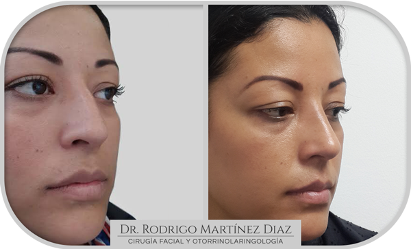 img_rinoplastia_P2