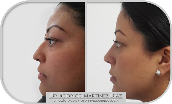 img_rinoplastia_P4