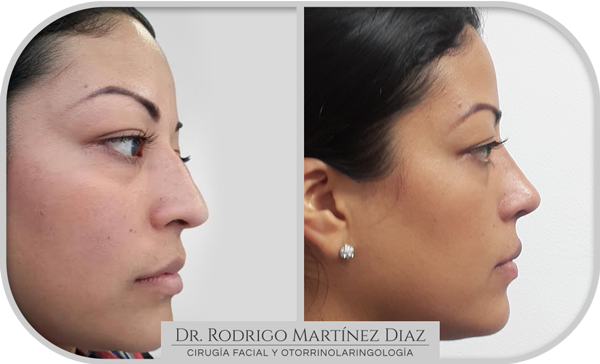 img_rinoplastia_P5