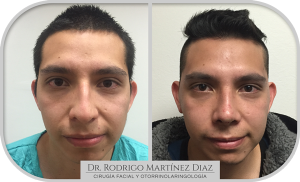 img_rinoplastia