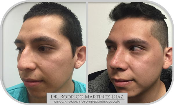 img_rinoplastia
