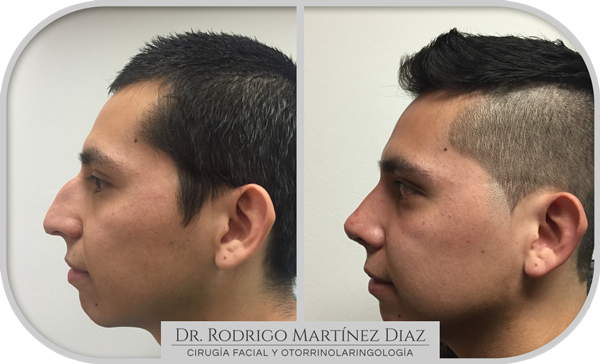 img_rinoplastia