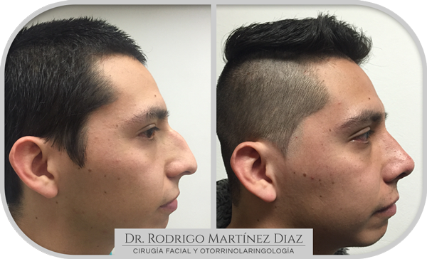 img_rinoplastia