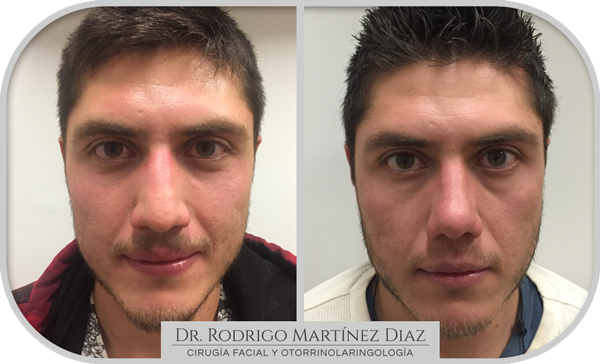 img_rinoplastia_U1