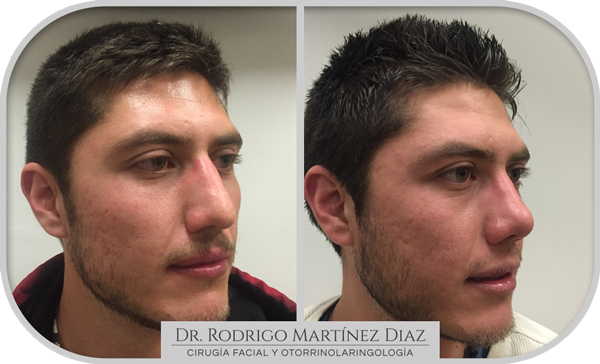 img_rinoplastia_U3