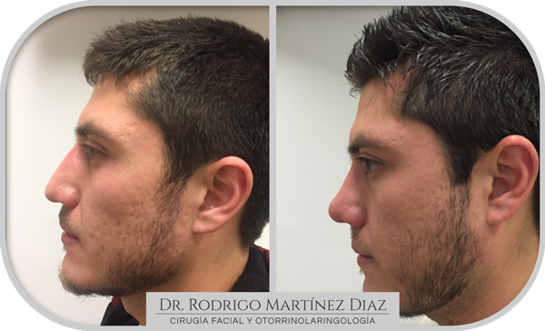 img_rinoplastia_U4