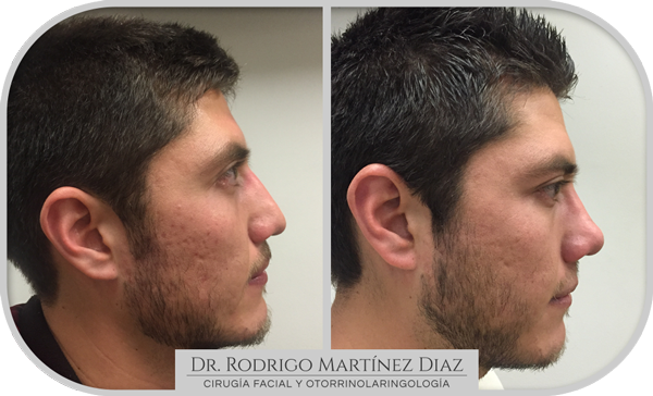 img_rinoplastia_U5