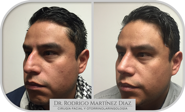 img_rinoplastia_V1