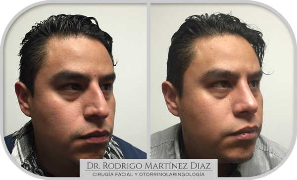 img_rinoplastia_V2