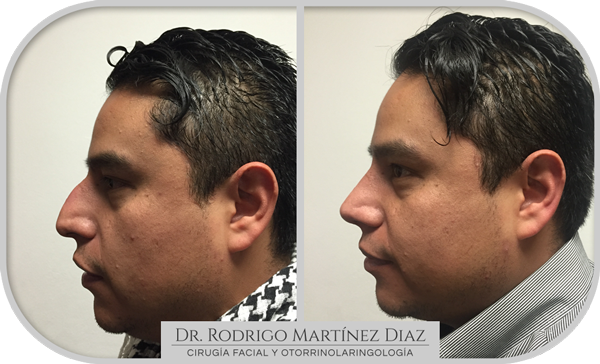 img_rinoplastia_V3