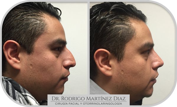 img_rinoplastia_V4