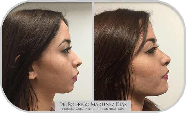 img_liposuccion cuello