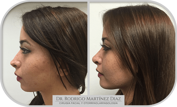 img_liposuccion cuello