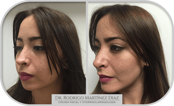 img_liposuccion cuello