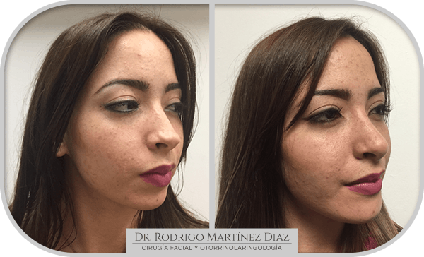 img_liposuccion cuello