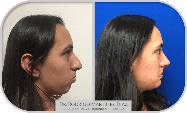 img_liposuccion cuello