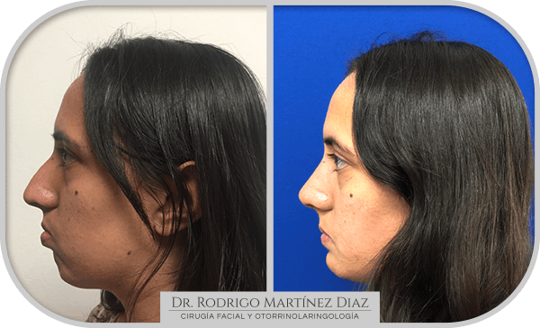 img_liposuccion cuello