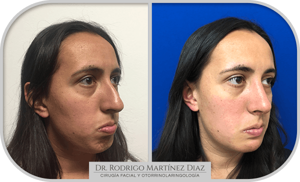 img_liposuccion cuello