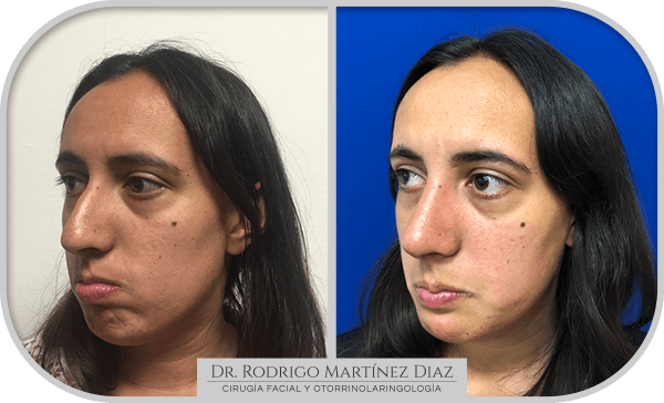 img_liposuccion cuello